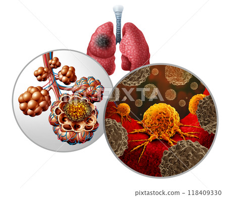 Alveolar Carcinoma lung cancer Alveolar Carcinoma lung cancer 118409330