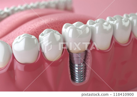 The concept of dental implants. A 3D rendering showing a dental implant placed between teeth 118410900