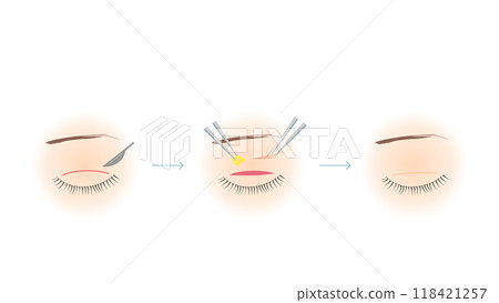 Double eyelid surgery illustration Double eyelid surgery illustration 118421257