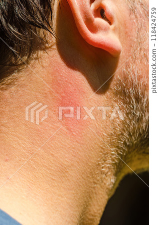 mosquito bites ticks on male neck closeup. High quality photo 118424759