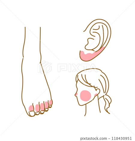 Illustrations of areas where chilblains often occur (feet, ears, cheeks) 118430951