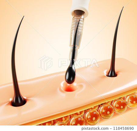 3d hair transplant render macro background. Follicle transplantation process to scalp with medical instrument. Baldness treatment, loss problem, alopecia control method, restoration. 3D illustration 118458690