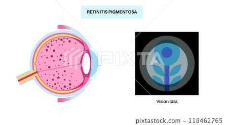 Retinitis pigmentosa poster 118462765