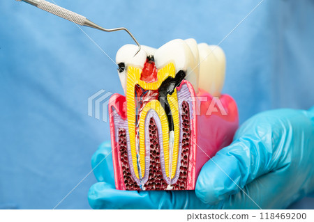 Asian dentist holding dental implant, artificial tooth roots into jaw, root canal of dental treatment, gum disease, teeth model for dentist. 118469200