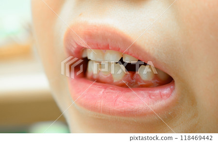 牙齒掉了 118469442