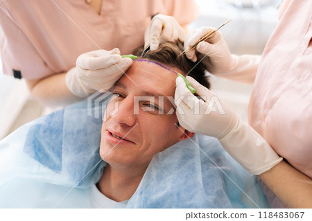 Close-up of unrecognizable trichologist surgeons carry out hair transplant surgery in operating room to patient with hairloss problem. Surgical technique that moves hair follicles from part of head. Close-up of unrecognizable trichologist surgeons carry out hair transplant surgery in operating room to patient with hairloss problem. Surgical technique that moves hair follicles from part of head. 118483067