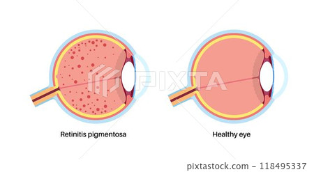 Retinitis pigmentosa poster 118495337