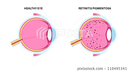 Retinitis pigmentosa poster 118495341