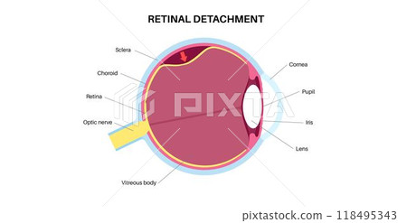 Retinal detachment eye disease Retinal detachment eye disease 118495343