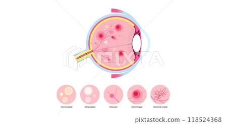 Diabetes related retinopathy 118524368