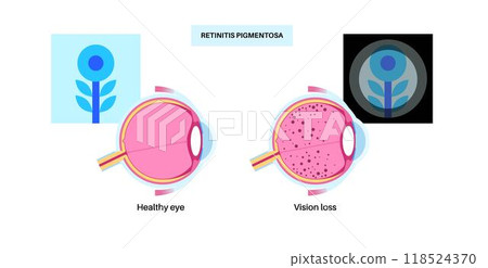 Retinitis pigmentosa poster 118524370