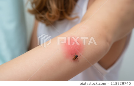 Close-up view of tick on human skin with red rash, insect attached to arm, health risk, Lyme disease carrier, medical alert, outdoor hazard Close-up view of tick on human skin with red rash, insect attached to arm, health risk, Lyme disease carrier, medical alert, outdoor hazard 118529740