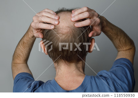 Close up of baldness men's head with thin hair on his top and back head. Close up of baldness men's head with thin hair on his top and back head. 118550930