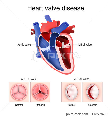 Heart valve disease. Healthy valve and Stenosis. 118578206