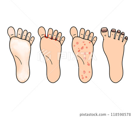 Types of ringworm (athlete's foot) (no letters) Types of ringworm (athlete's foot) (no letters) 118598578