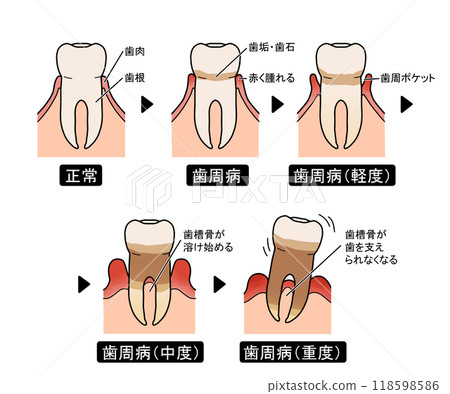 Progression of periodontal disease (with text) Progression of periodontal disease (with text) 118598586