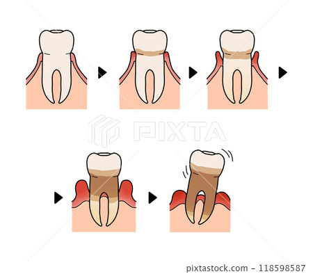 Progression of periodontal disease (no text) 118598587