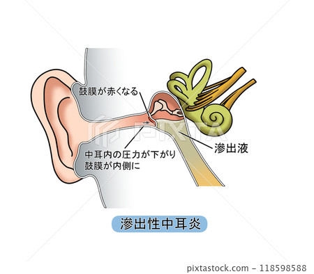 Serous otitis media (with text) 118598588