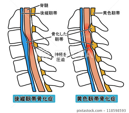 後縱韌帶骨化和黃韌帶骨化（附文字） 118598593
