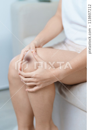 Bruise, wound and Contusion concepts. Woman having bruised on Knee and leg due to accident. Skin Injury, body pain and ache 118607212