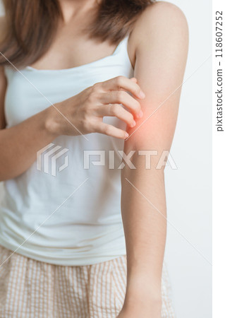 woman itching and scratching itchy arm. Sensitive Skin Allergic reaction to insect bite, food, drug dermatitis. Dermatology, Leprosy day, Systemic lupus erythematosus, Allergy symptoms and rash Eczema 118607252