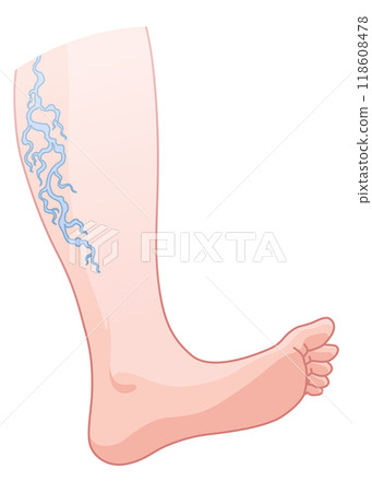 Varicose veins. Blue blood vessel visible through the skin, abnormally swollen leg. Vascular disease diagnostic and treatment. Venous insufficiency medical disease Varicose veins. Blue blood vessel visible through the skin, abnormally swollen leg. Vascular disease diagnostic and treatment. Venous insufficiency medical disease 118608478