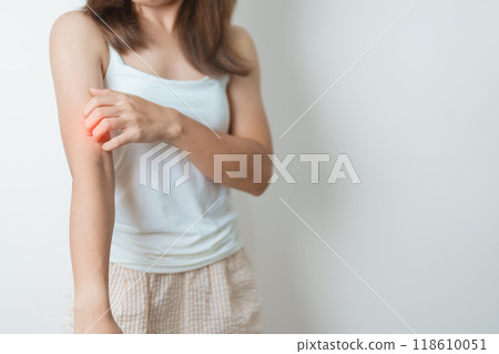woman itching and scratching itchy arm. Sensitive Skin Allergic reaction to insect bite, food, drug dermatitis. Dermatology, Leprosy day, Systemic lupus erythematosus, Allergy symptoms and rash Eczema 118610051