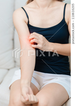 woman itching and scratching itchy arm. Sensitive Skin Allergic reaction to insect bite, food, drug dermatitis. Dermatology, Leprosy day, Systemic lupus erythematosus, Allergy symptoms and rash Eczema 118610205