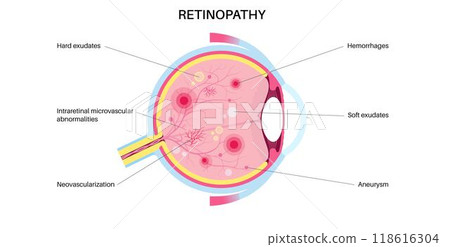 Diabetes related retinopathy 118616304