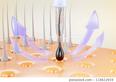 3d hair transplant procedure banner. Follicular unit extraction. Scalp with follicle, graft removal punch and infographic arrows. Hair restoration surgery, baldness treatment concept. 3D illustration 118622659