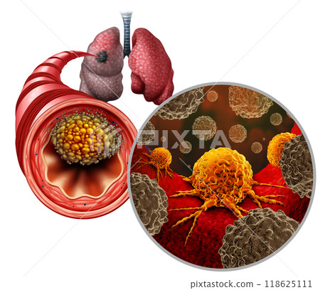Small Cell Lung Cancer 118625111