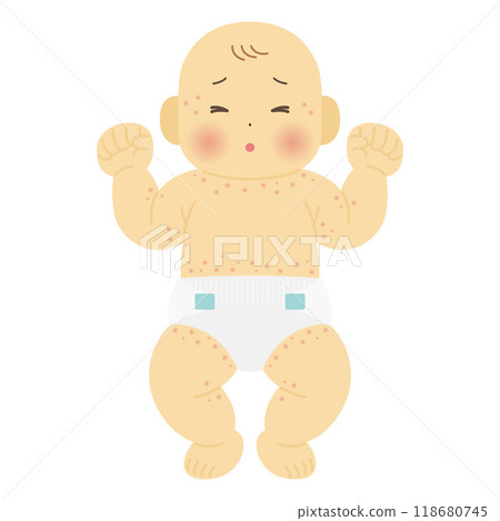 Illustration of a baby with eczema - Stock Illustration [118680745] - PIXTA