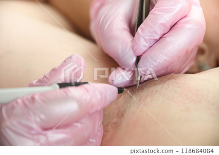 Procedure removal of hair permanently in a womans armpits using metod electro epilation. Procedure removal of hair permanently in a womans armpits using metod electro epilation. 118684084