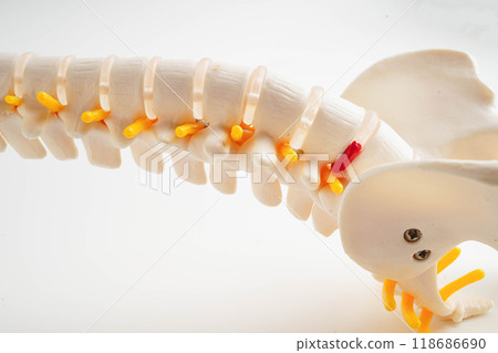 Spinal nerve and bone, Lumbar spine displaced herniated disc fragment, Model for treatment medical in the orthopedic department. Spinal nerve and bone, Lumbar spine displaced herniated disc fragment, Model for treatment medical in the orthopedic department. 118686690