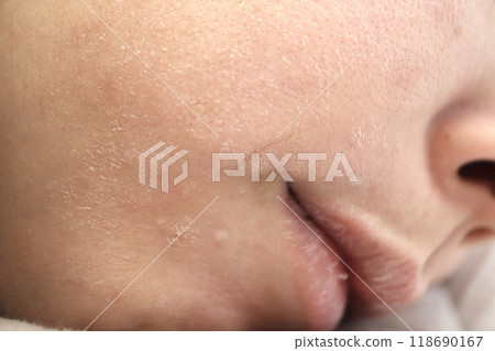 Close up of woman's facial skin with dry skin 118690167