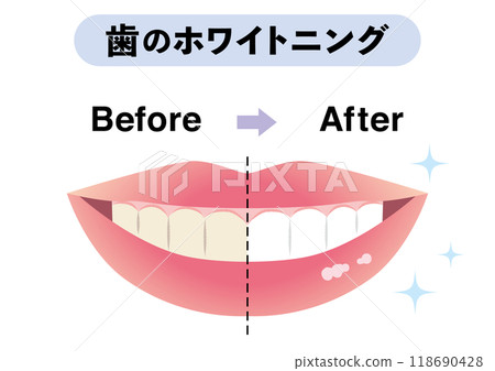 Before and after teeth whitening 118690428