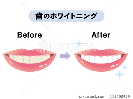 牙齒美白前後 118690429