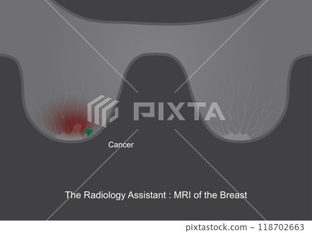 The Radiology Assistant MRI of the Breast. The Radiology Assistant MRI of the Breast. 118702663