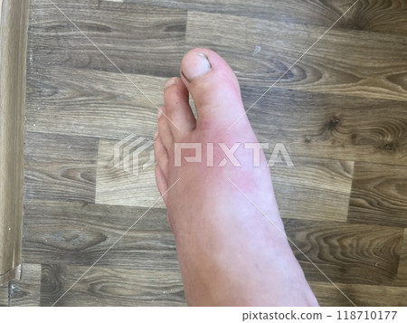 A man's leg with the gout 118710177