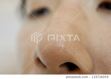 Pores on the nose of the face Strawberry nose 118726059