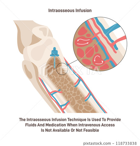 Intraosseous injection technique. Process of injecting medications, fluids, or blood products directly into the marrow of a bone. Flat vector illustration Intraosseous injection technique. Process of injecting medications, fluids, or blood products directly into the marrow of a bone. Flat vector illustration 118733838