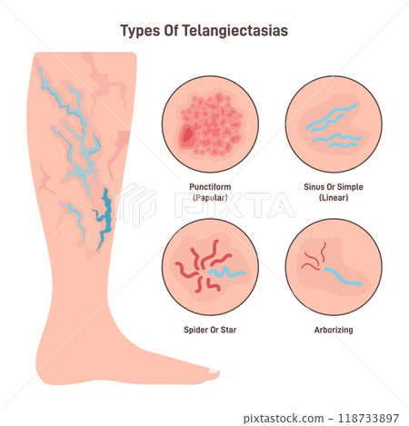 Telangiectasia types set. Varicose veins pattern, dilated blood vessels. Damaged capillaries obstruct blood flow. Flat vector illustration Telangiectasia types set. Varicose veins pattern, dilated blood vessels. Damaged capillaries obstruct blood flow. Flat vector illustration 118733897