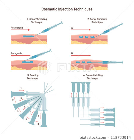 Cosmetic injection technique set. Filler hyaluronic acid facial injection. Anti-aging and skin revitalization procedure linear, fanning and cross-hatching serum insertion. Flat vector illustration 118733914