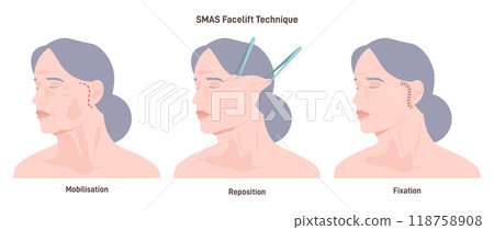 SMAS facelift surgery. Face features correction or anti-aging procedure. Idea of modern face aesthetic medicine. Skin elevation. Flat vector illustration SMAS facelift surgery. Face features correction or anti-aging procedure. Idea of modern face aesthetic medicine. Skin elevation. Flat vector illustration 118758908