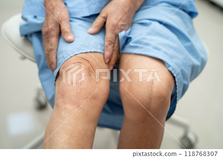 Asian elderly woman patient show her scars surgical total knee joint replacement Suture wound surgery arthroplasty. 118768307