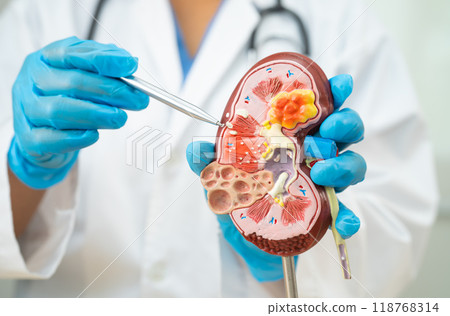 Kidney disease, Chronic kidney disease ckd, Doctor hold human model to treat and study in hospital. 118768314