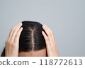A woman has a problem with hair loss. 118772613