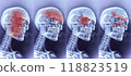 Different Types Of Headache, Migraine. Skull, Skeleton With Red Mark Of Painful Zones. Sinus, Cluster, And Tension. Medical Condition. AI Generated Horizontal. Healthcare, Medicine. 118823519