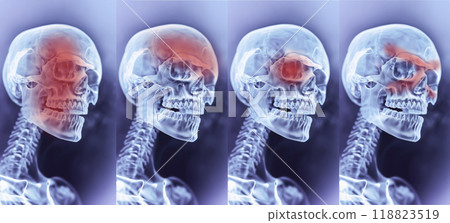 Different Types Of Headache, Migraine. Skull, Skeleton With Red Mark Of Painful Zones. Sinus, Cluster, And Tension. Medical Condition. AI Generated Horizontal. Healthcare, Medicine. 118823519