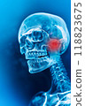 Temporomandibular disorder or TMJ on Skull. Pain in Jaw, tense, jaw area highlighted in red. Blue Background, Medical Condition, Illness. Healthcare, Medical Discomfort. Vertical. Chronic Facial Pain 118823675
